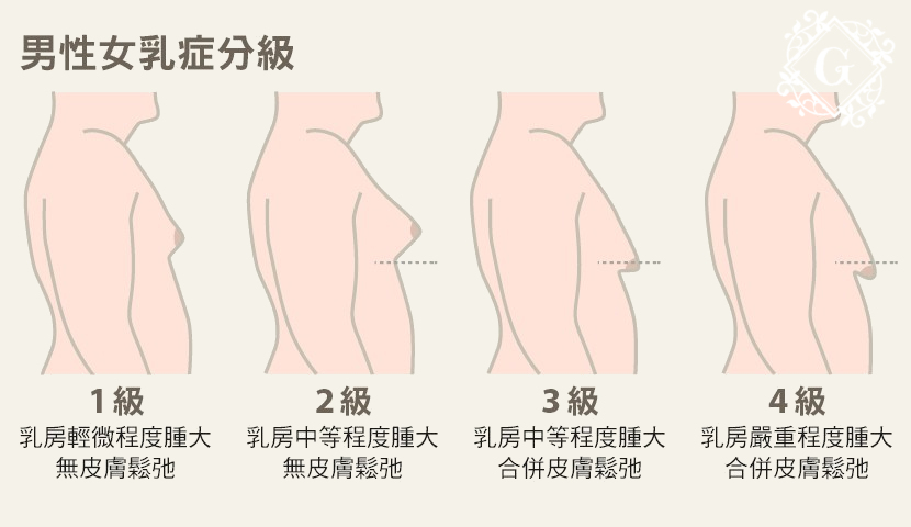 男性女乳症